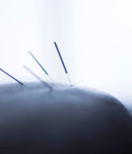 Dry Needling
